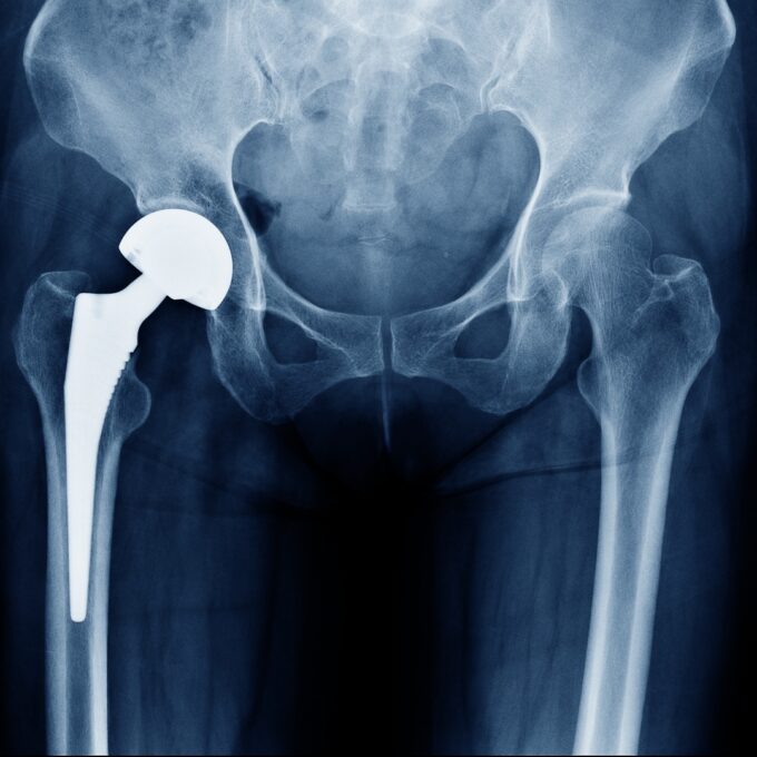 Hip Replacement X-Ray