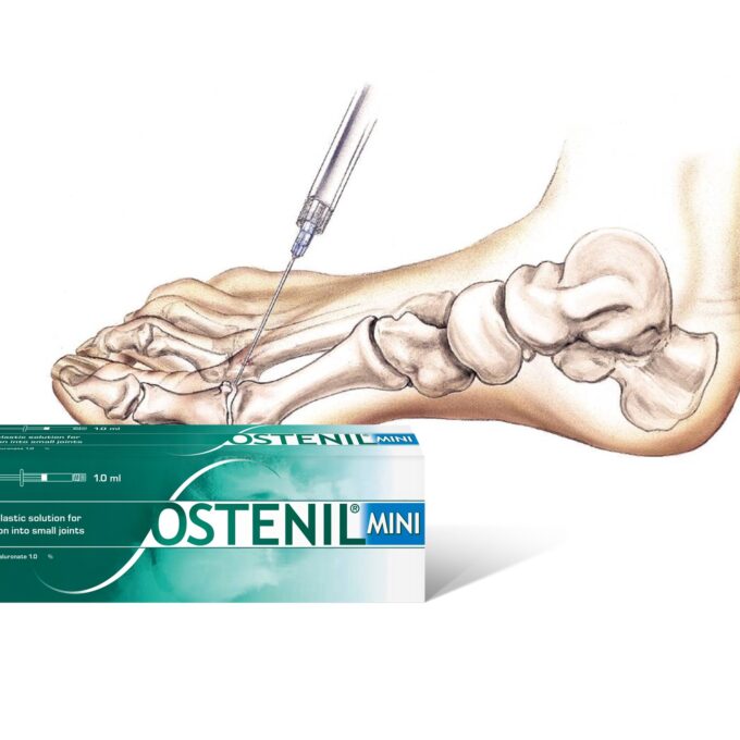 Ostenil Mini Toe injection